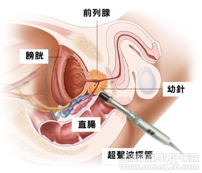 前列腺痛有哪些不为人知的症状?