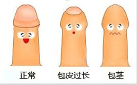 包皮过长会对男性造成多大的伤害?