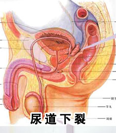尿道下裂