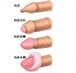 包皮炎症
