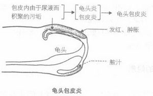 导致包皮龟头炎的原因是什么