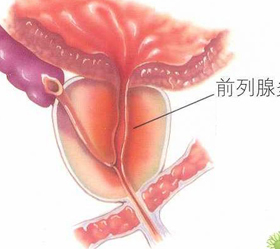 怎样可以缓解男性急性急性前列腺痛