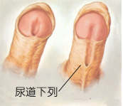 引发尿道下裂的因素有哪些?