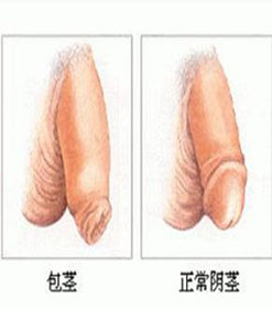 男性包茎如何自我诊断?