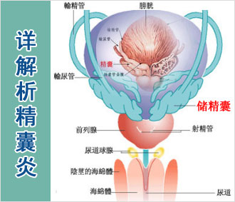 得了精囊炎真的会导致不育吗?