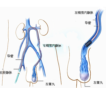 精索静脉曲张影响性功能吗?