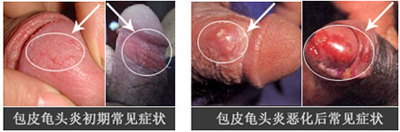 治疗包皮龟头炎哪家医院好?
