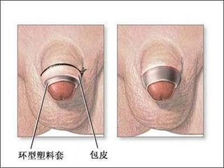 包皮过长会引起什么不良影响